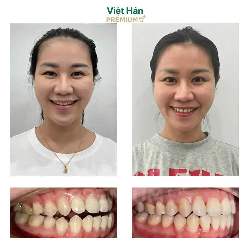 Khách hàng niềng răng thẩm mỹ tại nha khoa Việt Hàn Premium Thủ Dầu Một Bình Dương