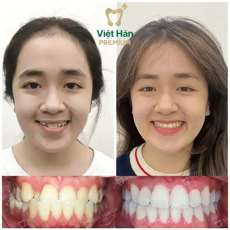 Khách hàng niềng răng thẩm mỹ tại nha khoa Việt Hàn Premium Thủ Dầu Một Bình Dương