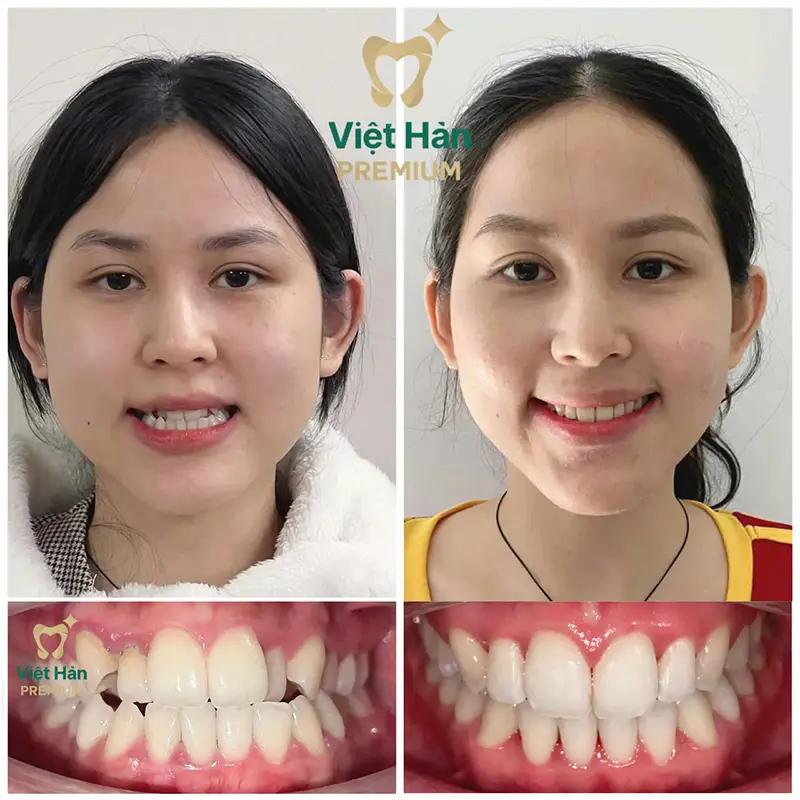 Khách hàng niềng răng thẩm mỹ tại nha khoa Việt Hàn Premium Thủ Dầu Một Bình Dương