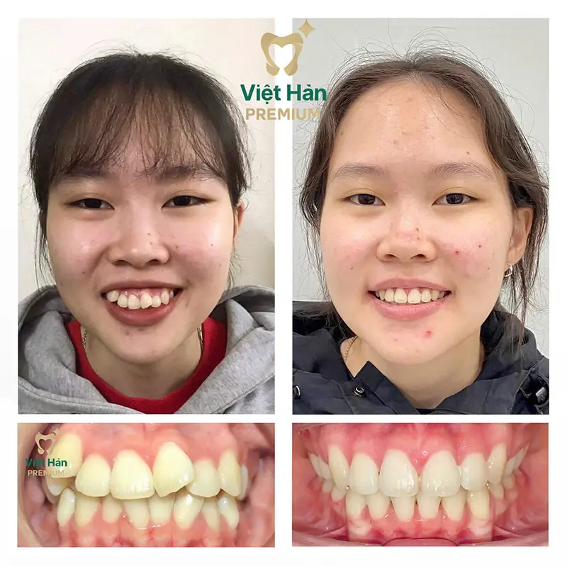 Khách hàng niềng răng thẩm mỹ tại nha khoa Việt Hàn Premium Thủ Dầu Một Bình Dương