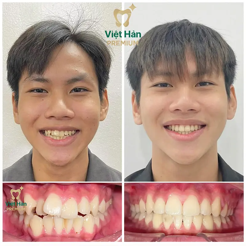 Khách hàng niềng răng thẩm mỹ tại nha khoa Việt Hàn Premium Thủ Dầu Một Bình Dương