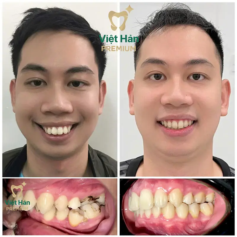 Khách hàng niềng răng thẩm mỹ tại nha khoa Việt Hàn Premium Thủ Dầu Một Bình Dương