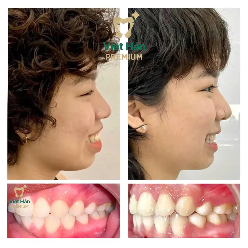Khách hàng niềng răng thẩm mỹ tại nha khoa Việt Hàn Premium Thủ Dầu Một Bình Dương