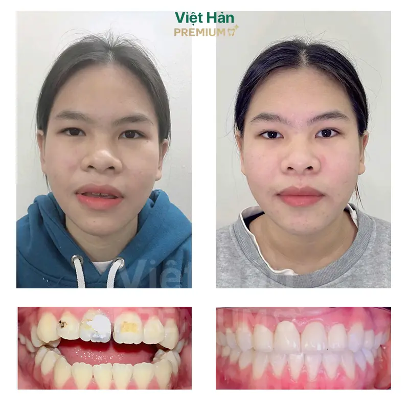 Khách hàng niềng răng thẩm mỹ tại nha khoa Việt Hàn Premium Thủ Dầu Một Bình Dương