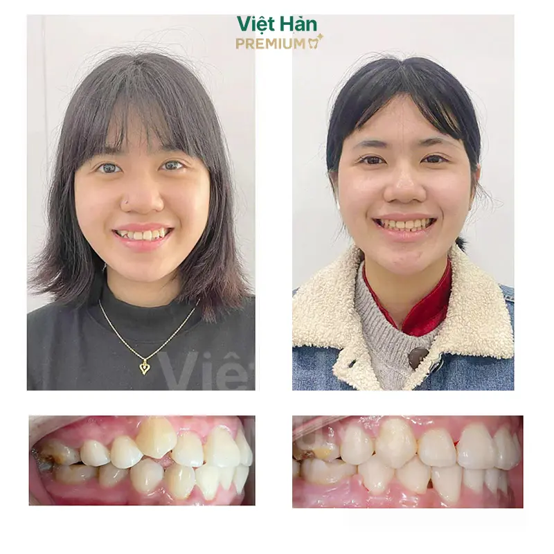 Khách hàng niềng răng thẩm mỹ tại nha khoa Việt Hàn Premium Thủ Dầu Một Bình Dương