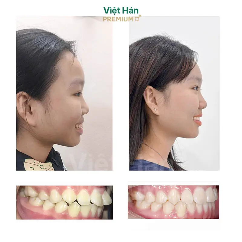 Khách hàng niềng răng thẩm mỹ tại nha khoa Việt Hàn Premium Thủ Dầu Một Bình Dương