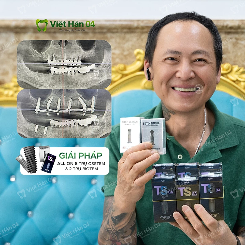 Khách hàng Quốc Bảo - Việt Kiều Mỹ - Cấy ghép Implant toàn hàm tại Nha khoa Việt Hàn 04