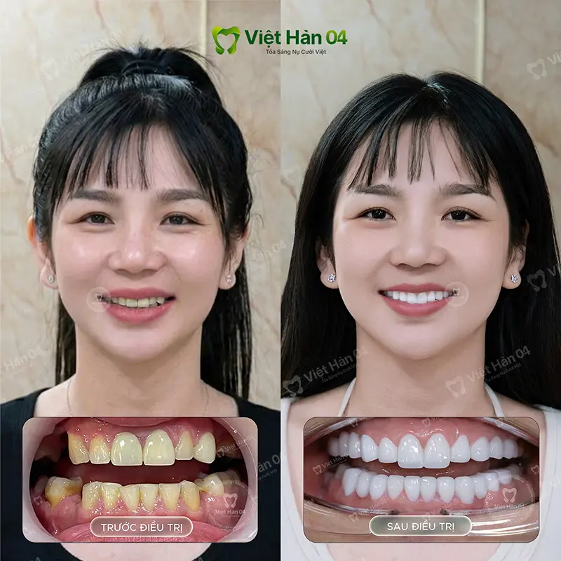 Khách hàng Quyền Trân - Bọc 20 răng sứ Lava Plus