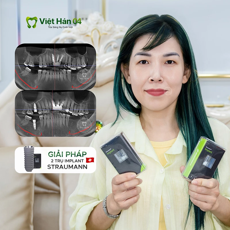Khách hàng Tuyết Phượng - Việt Kiều Đài Loan - Cấy ghép Implant đơn lẻ tại Nha khoa Việt Hàn 04