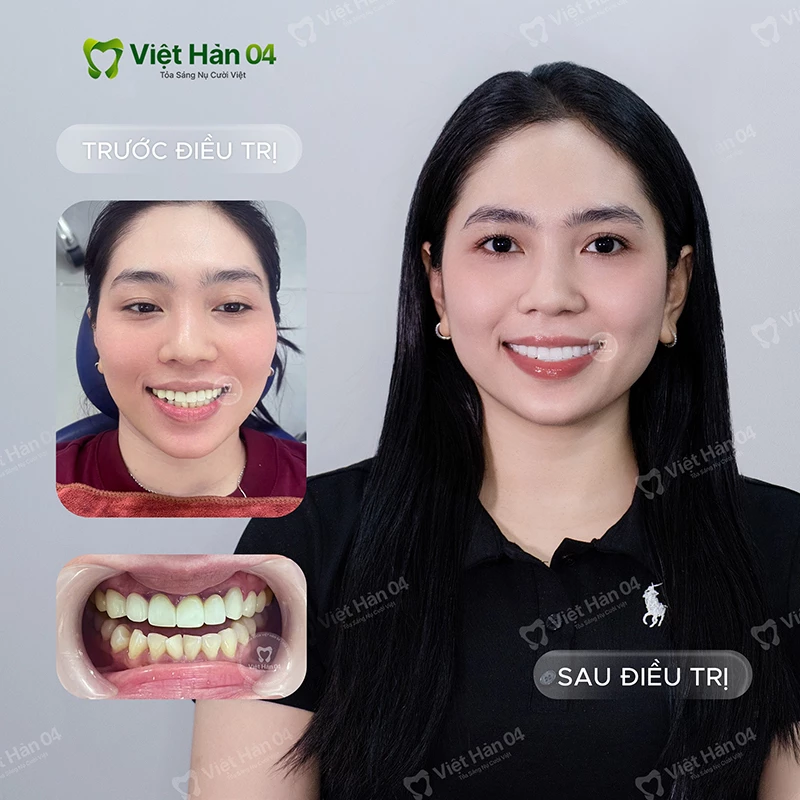 Khách hàng Zaroh làm sứ nguyên hàm - Nha Khoa Việt Hàn 04