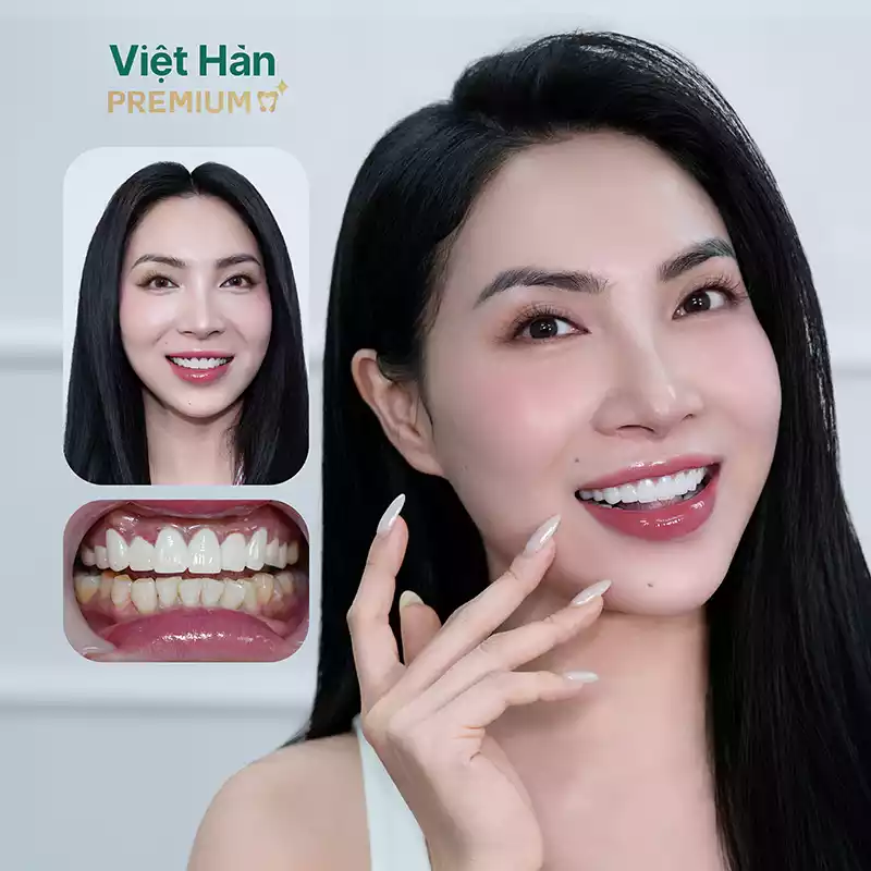 Hình ảnh khách hàng bọc răng sứ hàm trên tại nha khoa Việt Hàn Premium