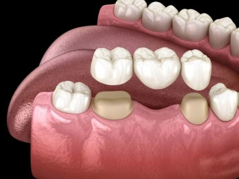 Làm cầu răng sứ phục hồi chức năng ăn nhai tốt