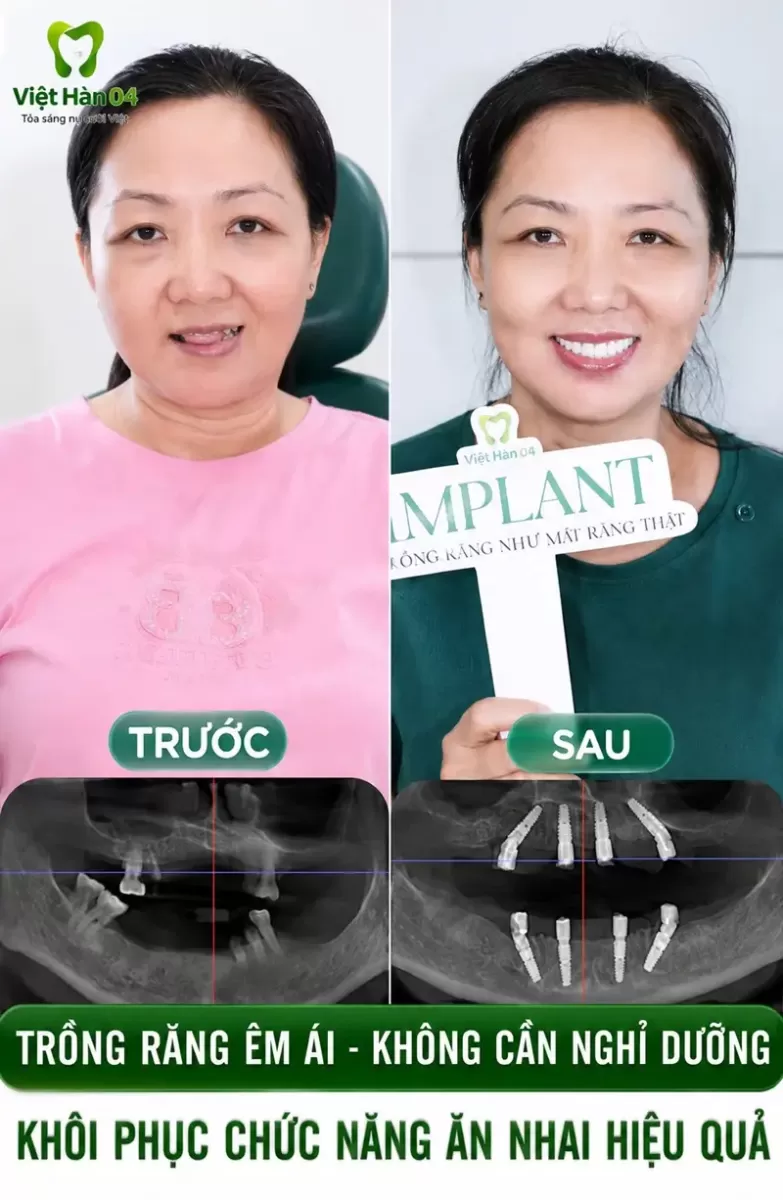 Lên kế hoạch điều trị cấy ghép Implant dựa trên tình trạng của khách hàng