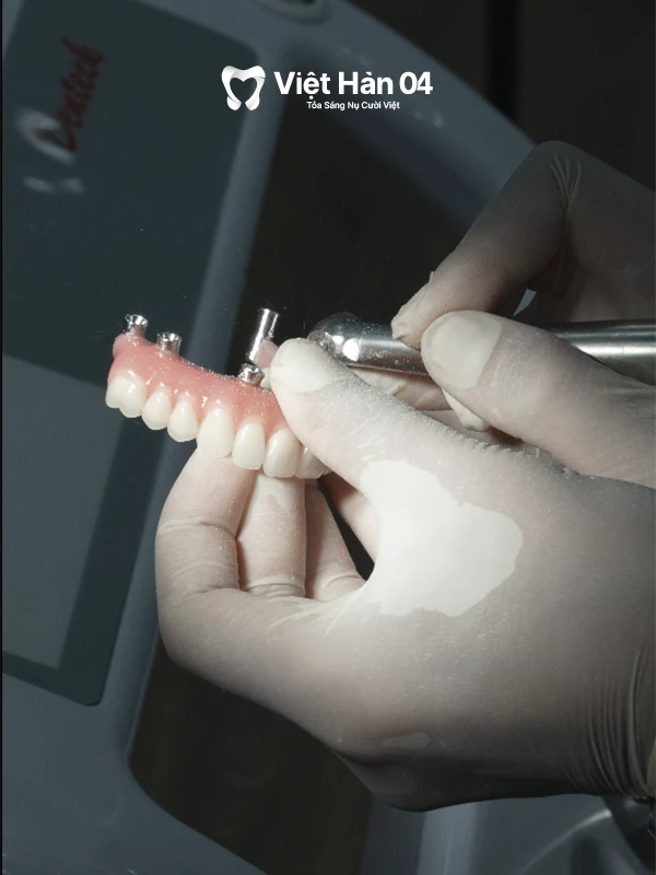 Lên răng thẩm mỹ (Đối với trường hợp trồng răng Implant toàn hàm)