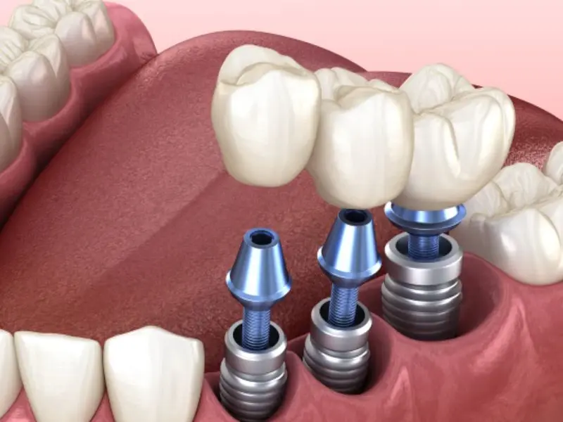 Lựa chọn trụ Implant phù hợp với tình trạng mất răng