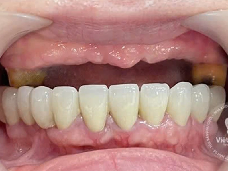 Mất răng toàn hàm trên trước khi cắm implant