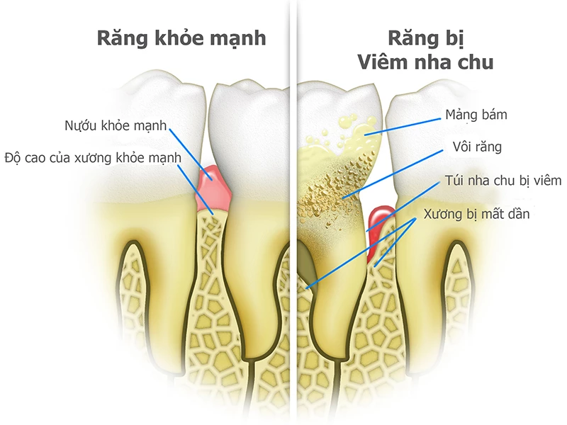 So sánh răng khỏe mạnh và các giai đoạn viêm nha chu, tiêu xương