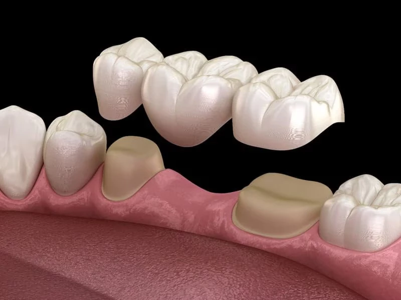 Phương pháp cầu răng sứ phù hợp khi cần trồng răng nhanh chóng, tiết kiệm