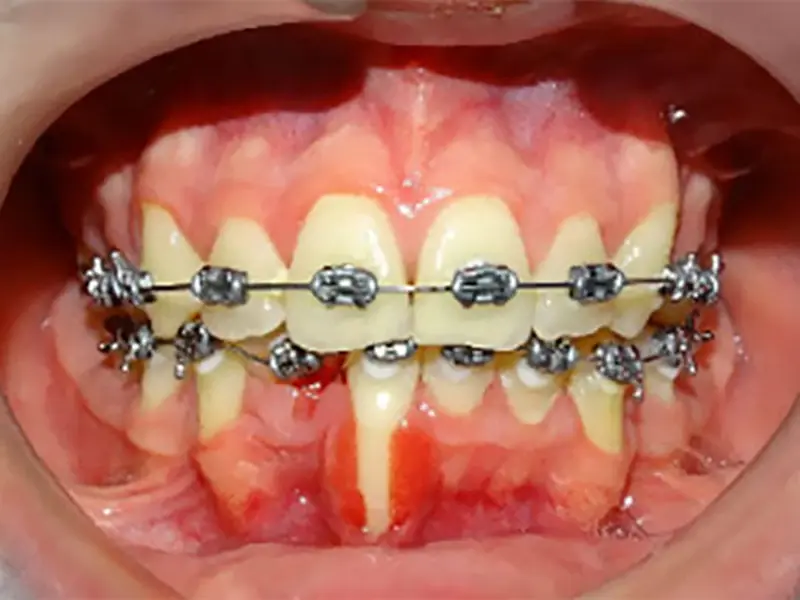 Nguy cơ viêm nhiễm và mắc các bệnh lý răng miệng nghiêm trọng