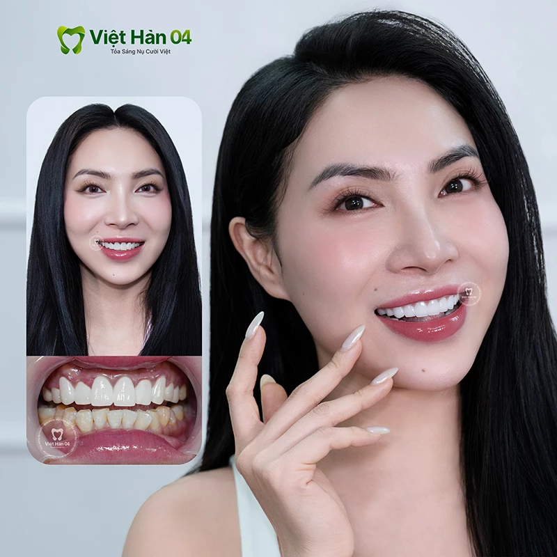 Tiktoker Trish Phan làm răng sứ tại nha khoa Việt Hàn 04
