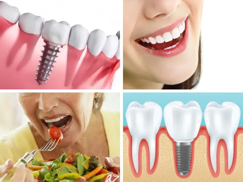 Những lợi ích khi lựa chọn cấy ghép Implant