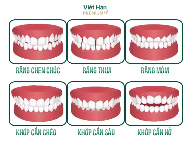 Những tình trạng nên niềng răng