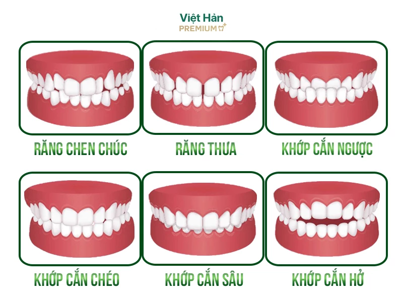 Những trường hợp nên niềng răng - Nha Khoa Việt Hàn Premium