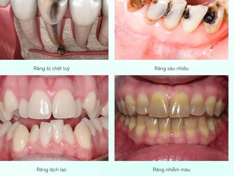 Những trường hợp nên trồng răng sứ
