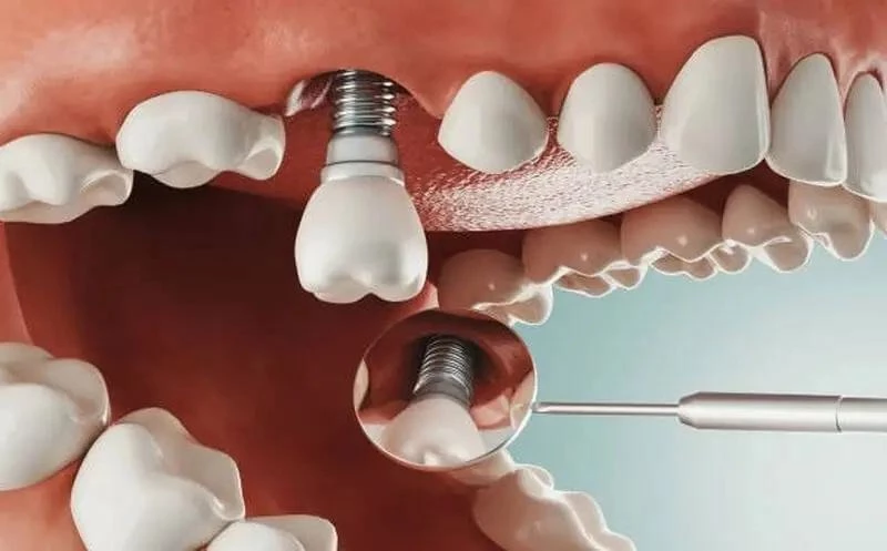 Trồng răng implant mang lại độ bền vượt trội