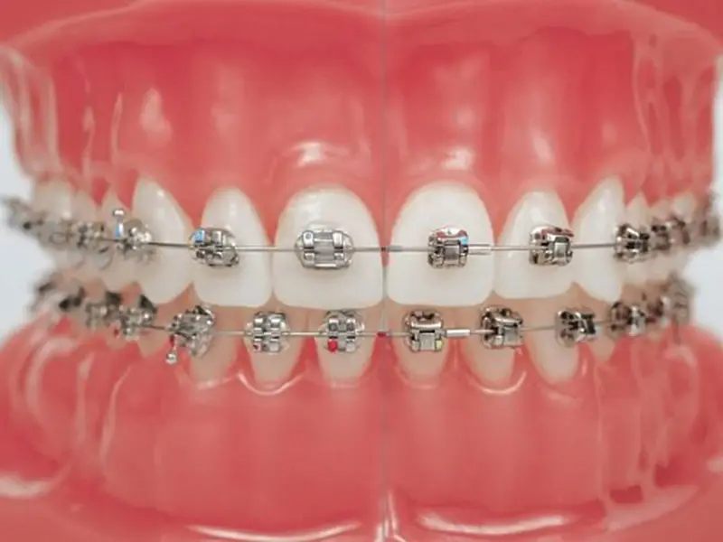 Niềng răng thẩm mỹ mắc cài kim loại mỹ