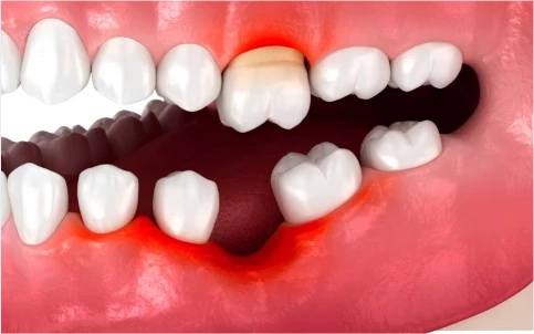 Tình trạng tiêu xương ổ răng phổ biến