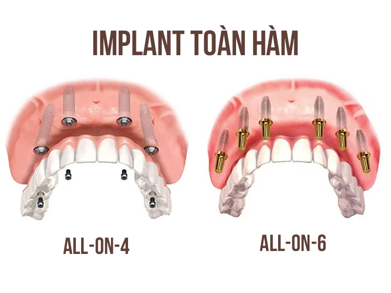 Implant toàn hàm all on 4 - all on 6