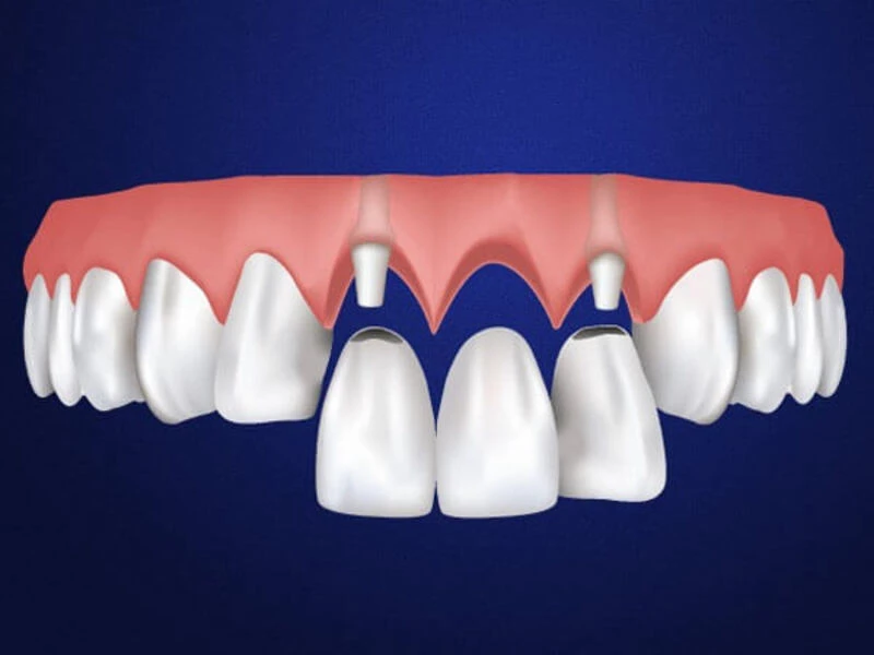 Phục hình răng cửa bị mất bằng phương pháp làm cầu răng sứ thẩm mỹ