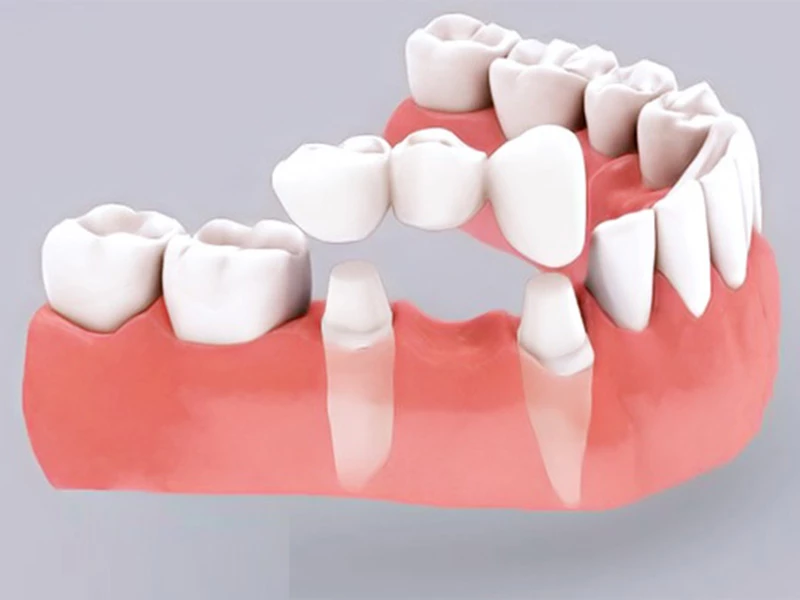 Phương pháp bắc cầu răng sứ