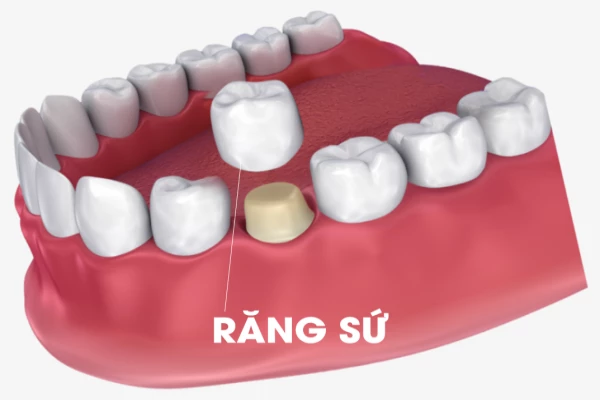 Phương pháp bọc răng sứ