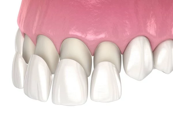 Phương pháp dán răng sứ Veneer