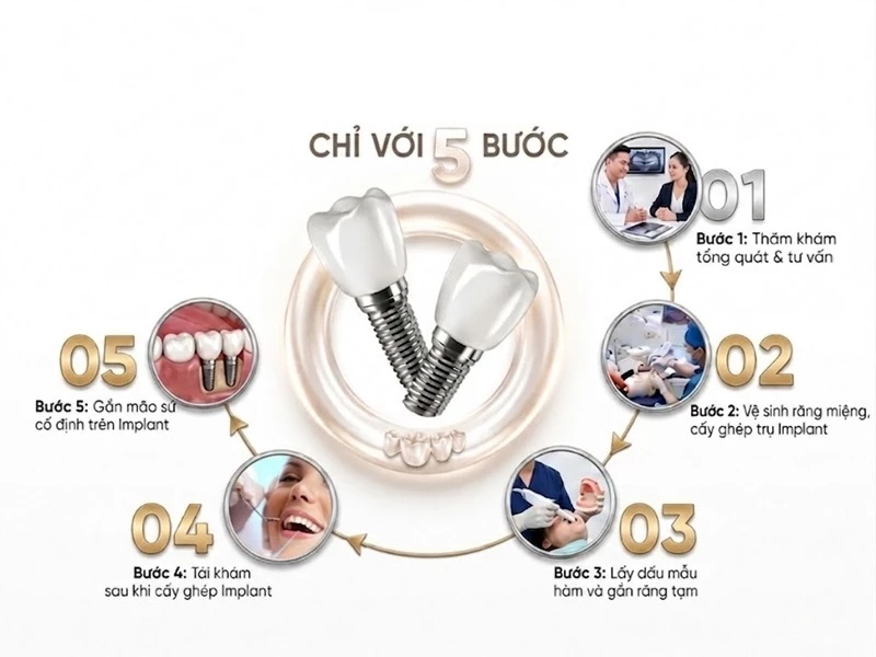 Quy trình cấy ghép Implant thực hiện theo các bước chuẩn y khoa đảm bảo an toàn và hiệu quả phục hình