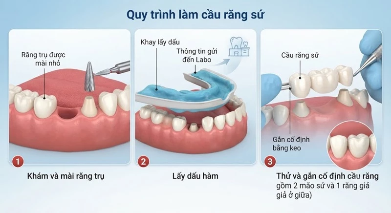 Quy trình làm cầu răng sứ đơn giản