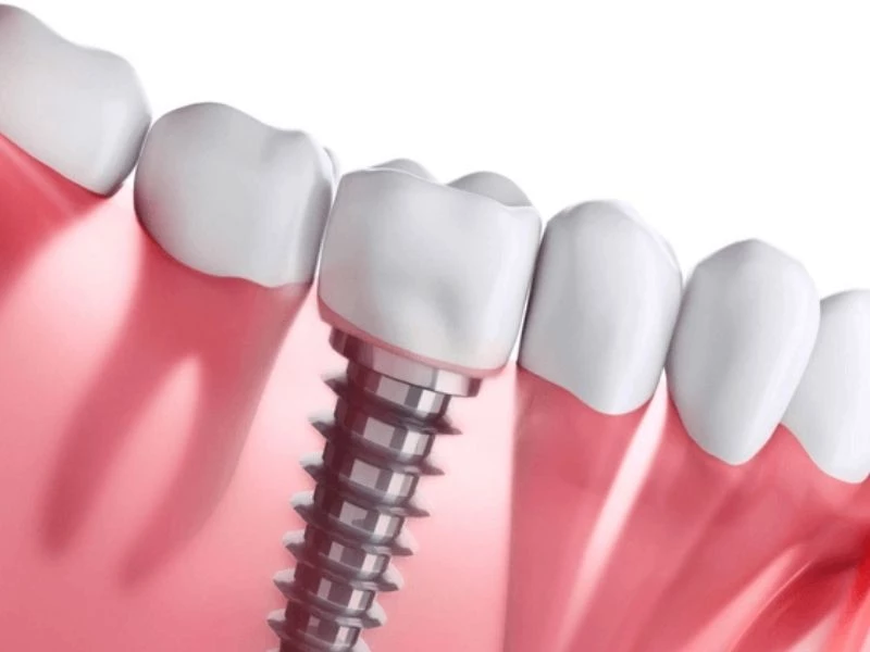 Quy trình trồng răng Implant bắt đầu bằng thăm khám và lập kế hoạch điều trị 