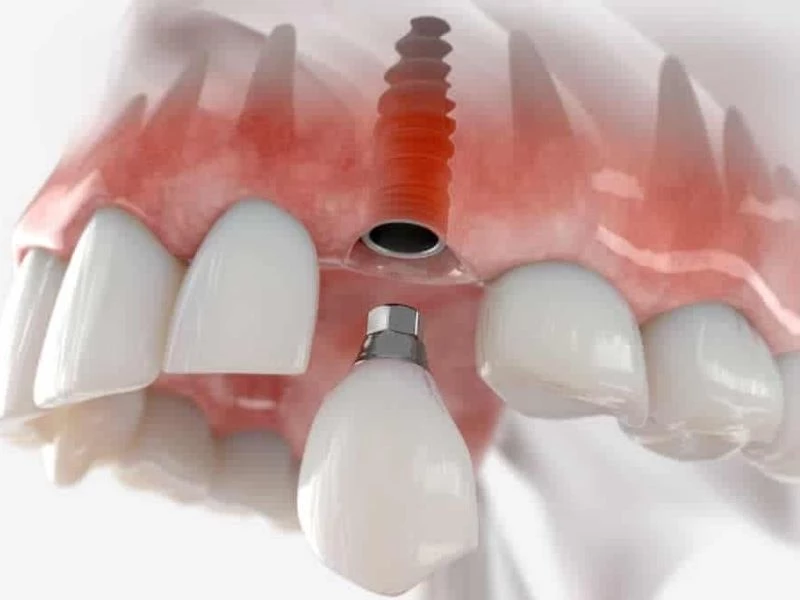 Quy trình trồng răng Implant hoàn thiện với mão sứ mang lại nụ cười tự nhiên