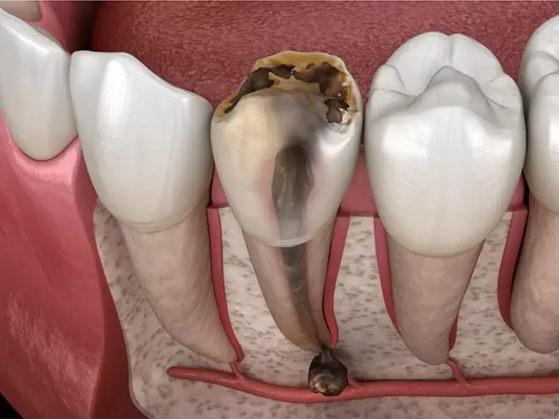 Răng bị chết tủy