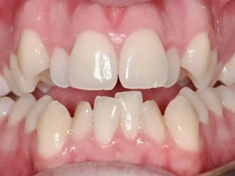 Răng lệch lạc