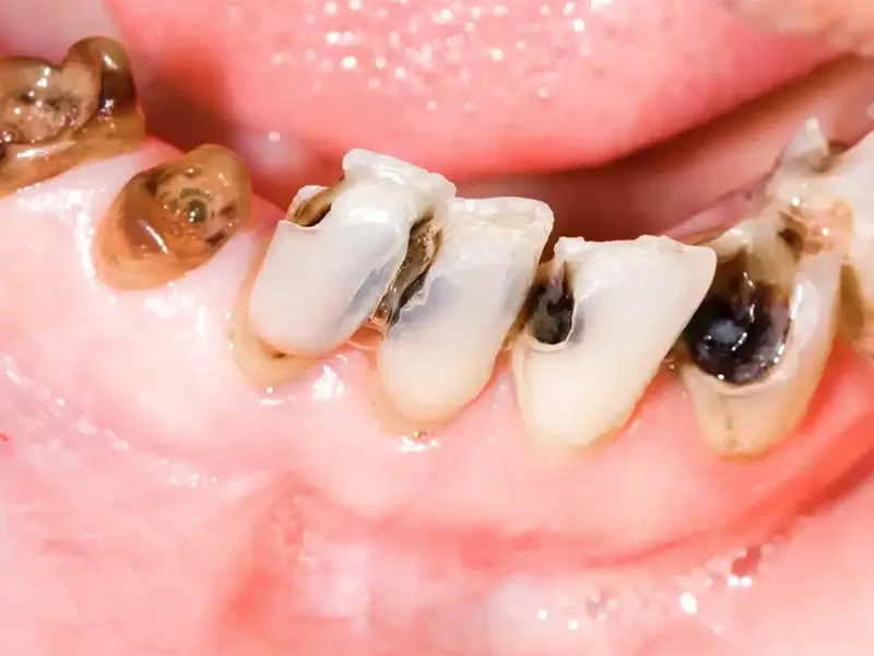 Răng bị sâu nhiều