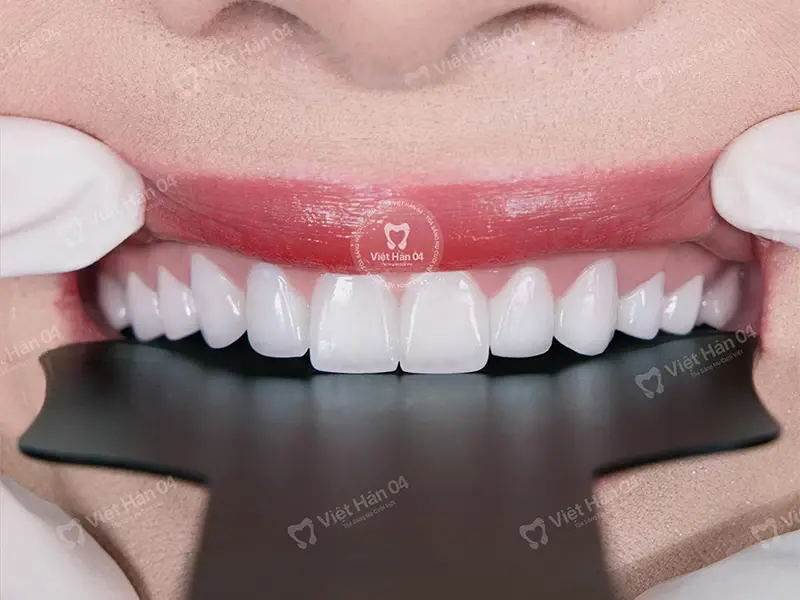 Răng sứ Cercon HT