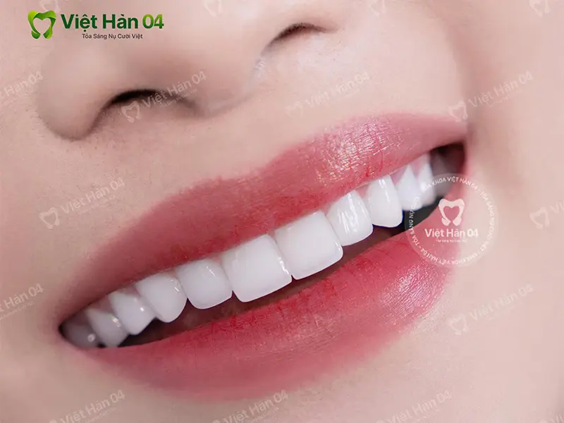 Răng sứ đẹp tự nhiên như răng thật