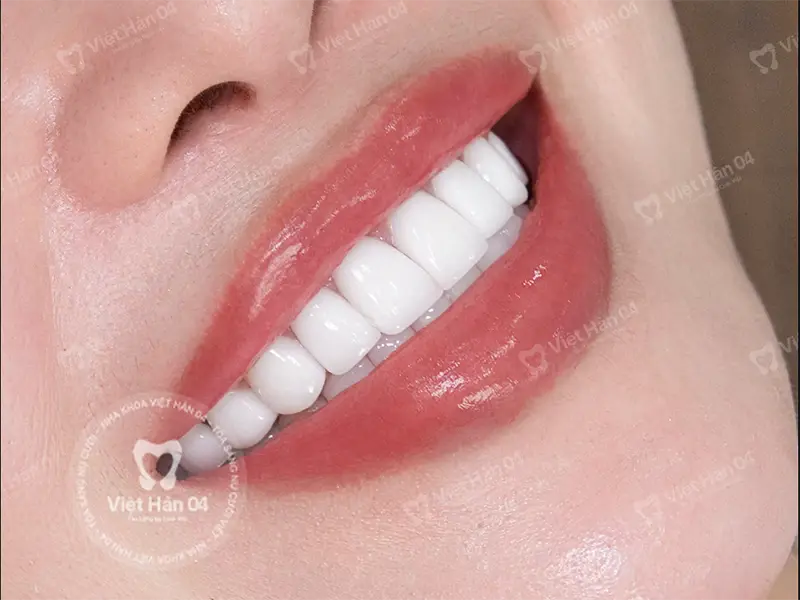 Xuất xứ của răng sứ Zirconia