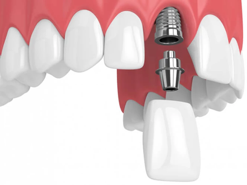 Hình minh họa phương pháp cấy ghép implant răng bị mất