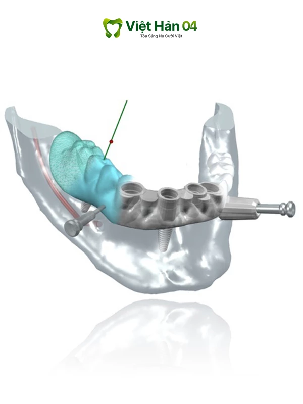Thiết kế máng định vị 3D