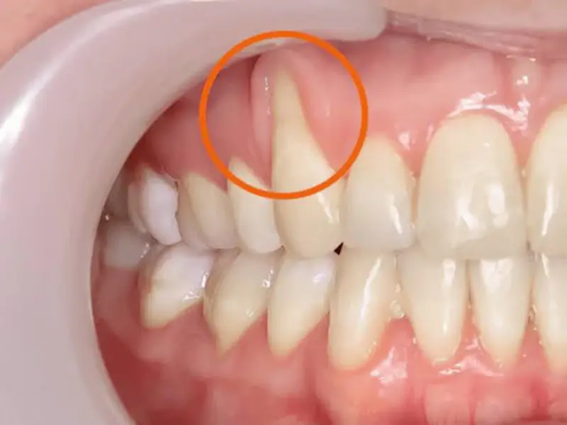 Tiêu xương hàm, bật chân răng ra ngoài