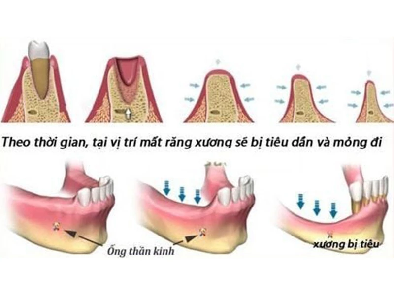 Có bao nhiêu dạng tiêu xương hàm